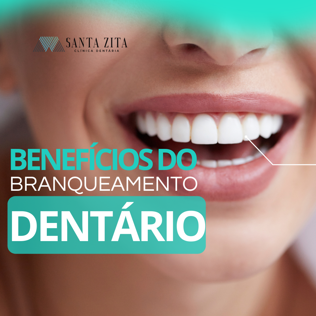 Benefícios de um Branqueamento Dentário