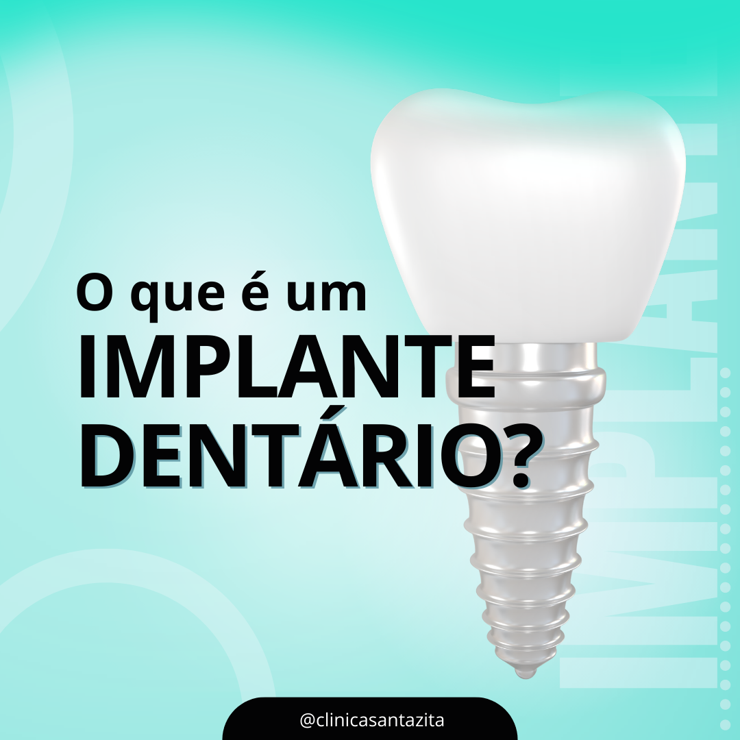 Implantes Dentários: Restaurando Sorrisos com Conforto e Segurança