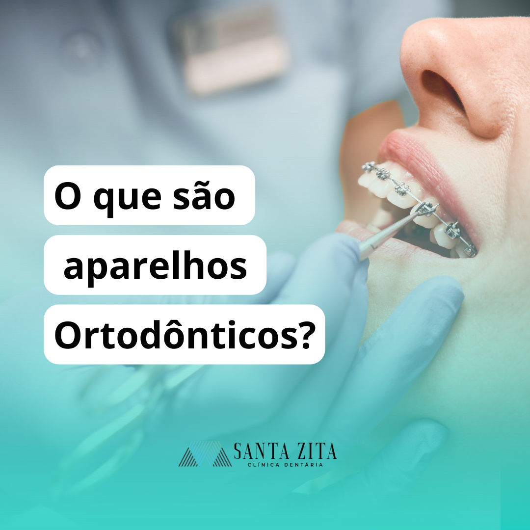Sorrisos Alinhados: Aparelhos Ortodônticos