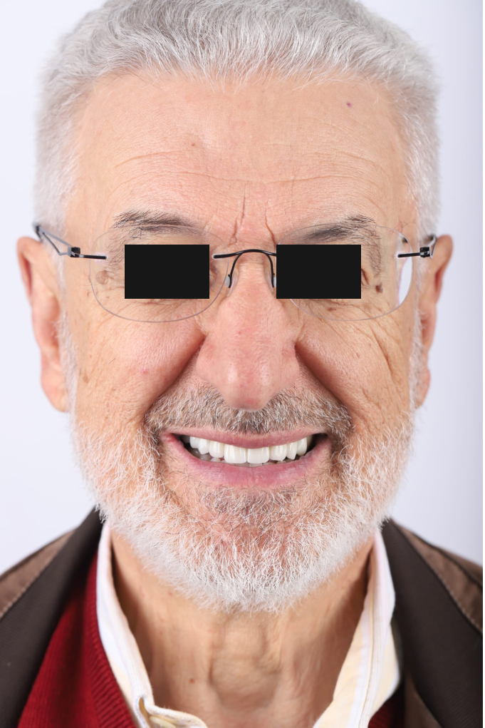 Tratamento Facetas Dentárias - Clinica Santa Zita