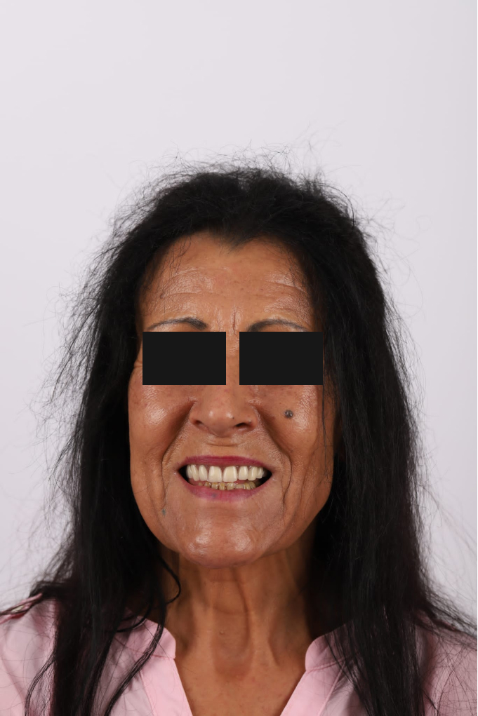Tratamento Facetas Dentárias - Clinica Santa Zita