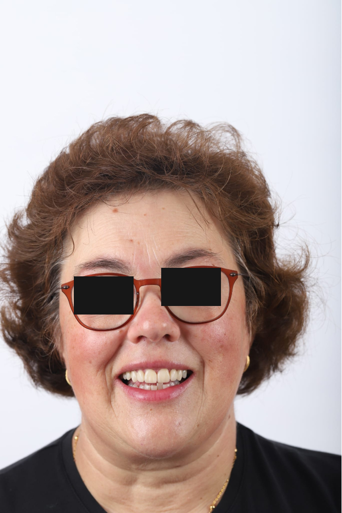 Tratamento Facetas Dentárias - Clinica Santa Zita