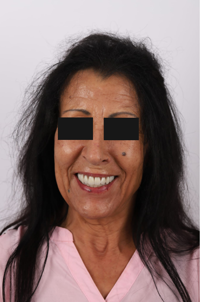 Tratamento Facetas Dentárias - Clinica Santa Zita