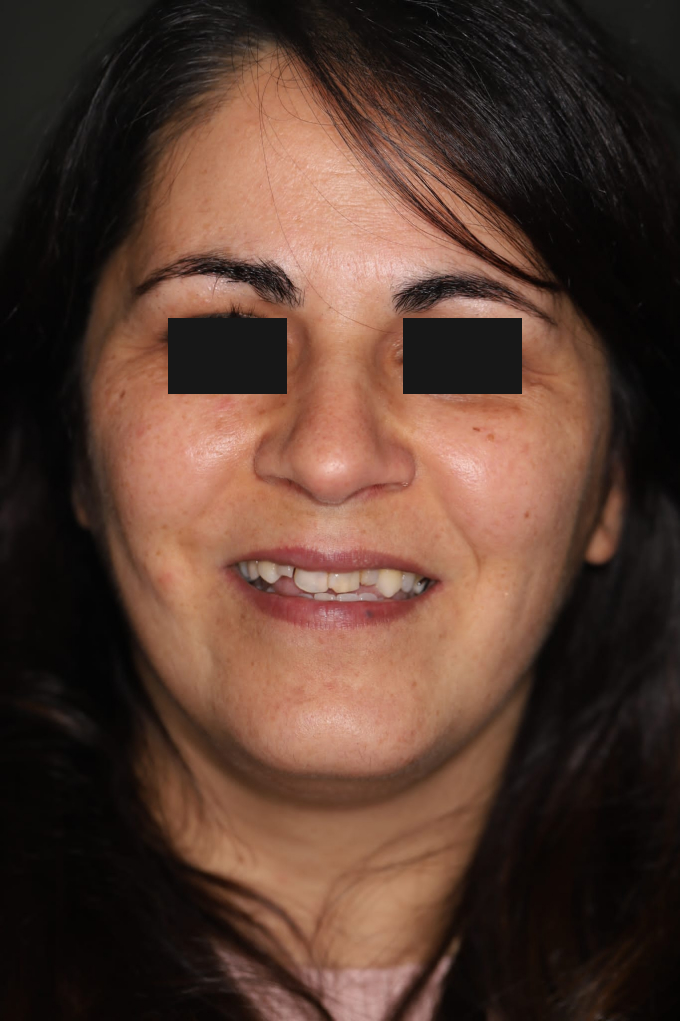 Tratamento Reabilitação Oral - Clinica Santa Zita