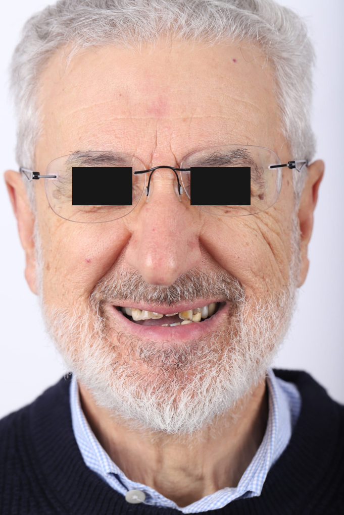 Tratamento Facetas Dentárias - Clinica Santa Zita
