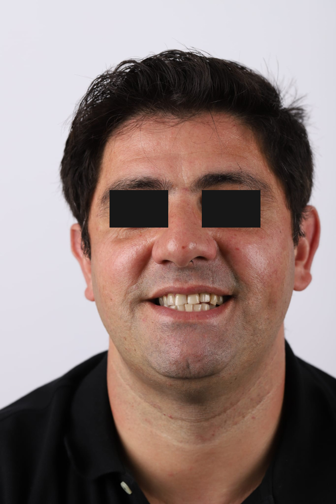 Tratamento Facetas Dentárias - Clinica Santa Zita