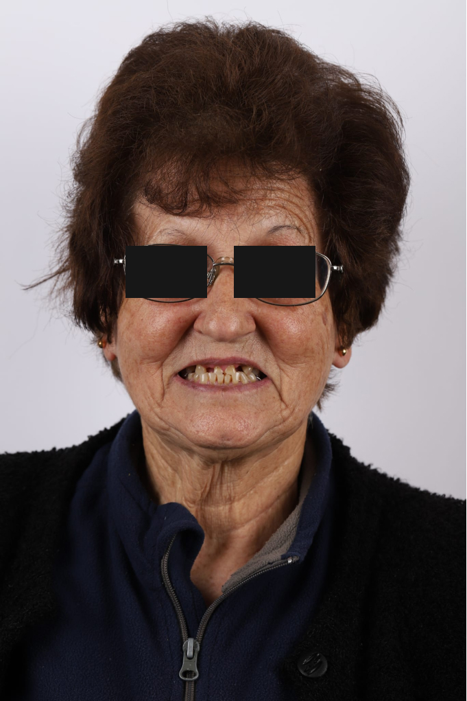 Implantes Dentários Clinica Santa Zita