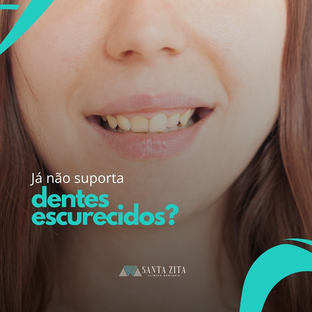 Branqueamento Dentário - Clínica Santa Zita