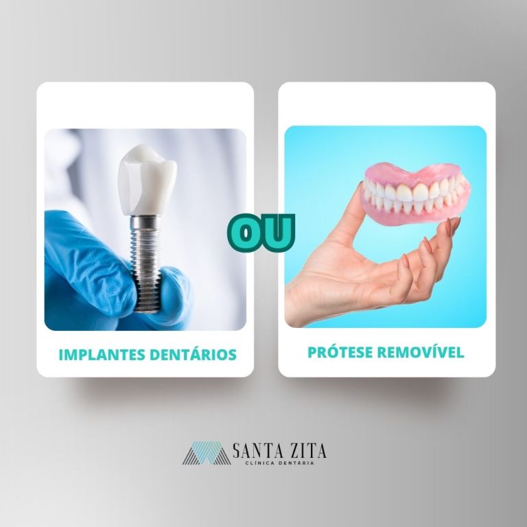 Implantes Dentários ou Próteses Removiveis