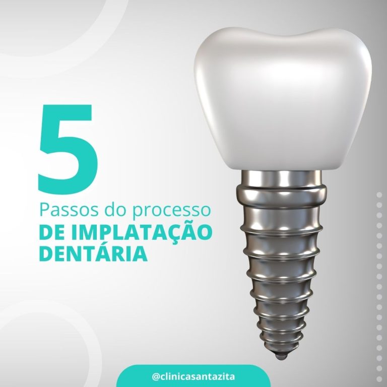 Clinica Santa Zita - Implantação Dentária
