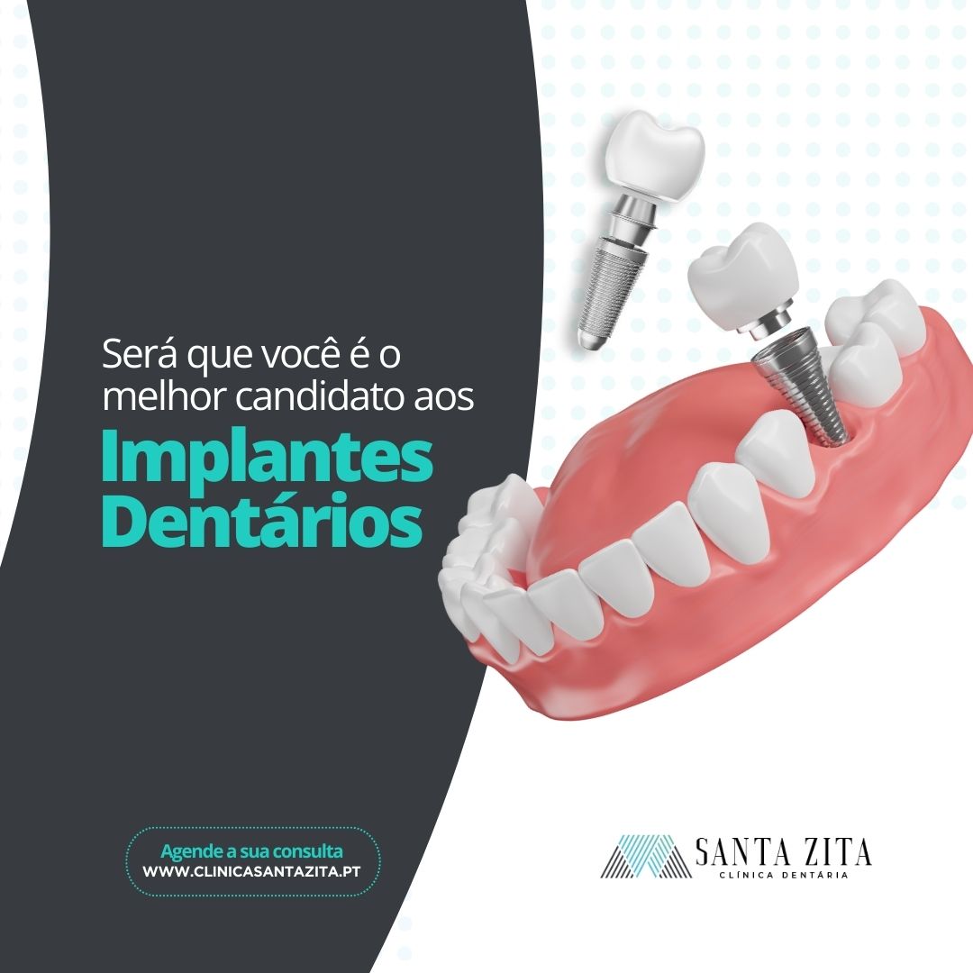 Requisitos para Implantes Dentários - Clinica Santa Zita